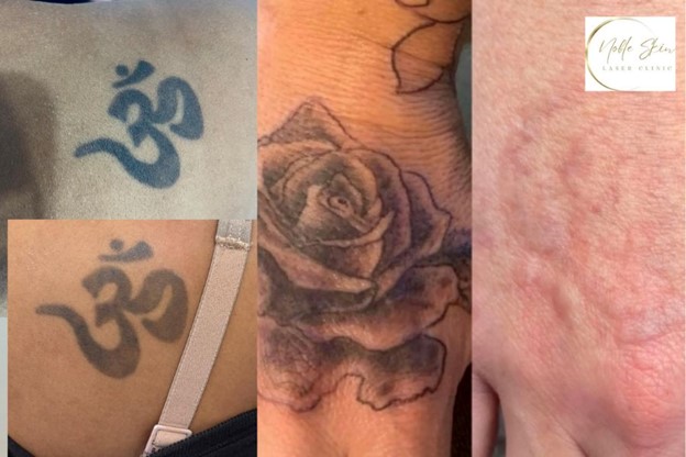 Let It Fade, Feel Like You Again: A Fresh Start for Your Skin in Campbelltown