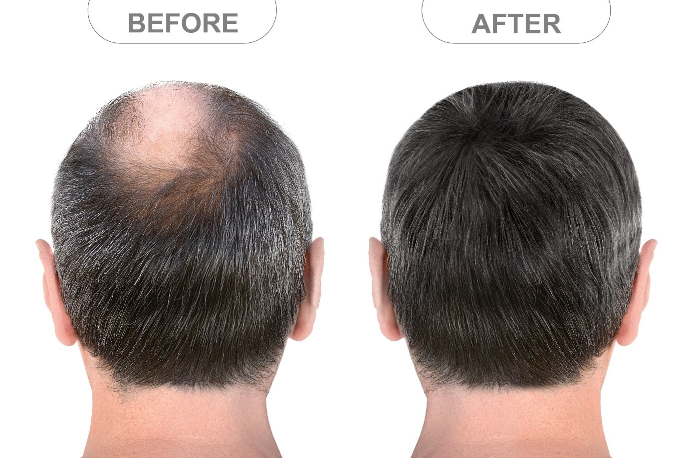 How to Choose the Right Hair Replacement System for Your Lifestyle