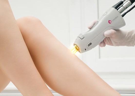 advanced laser hair removal